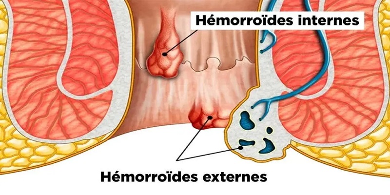 Hémorroïdes internes et hémorroïdes externes